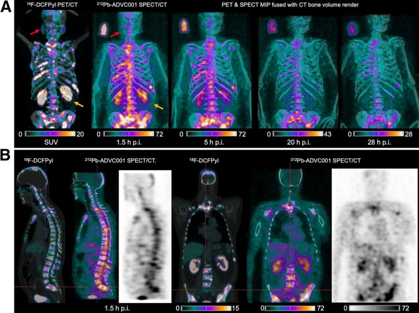 Prostate cancer: New SPECT/CT technique for greater treatment precision